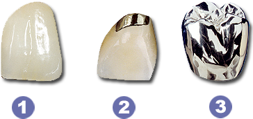 Illustration Zahnersatz aus Metall, Metall mit Keramikverblendung und Vollkeramik