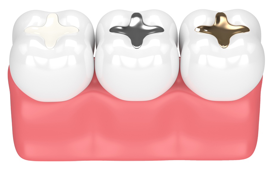 moderne Zahnfüllungen bei Karies